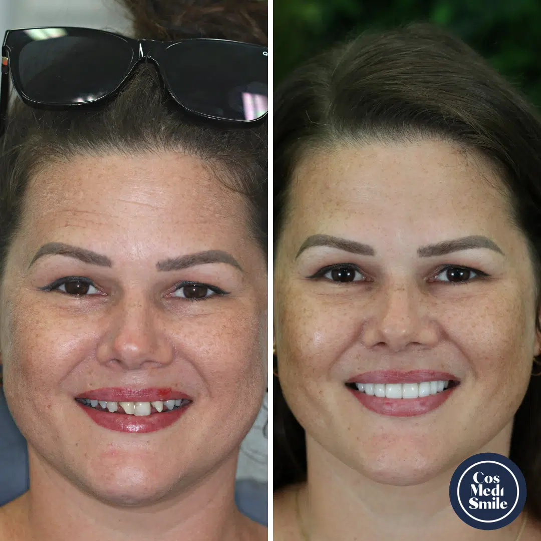 Smile Makeover 61, Porcelain Veneers Face