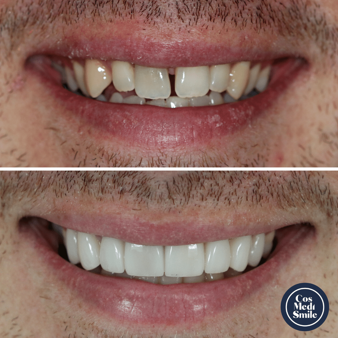 Smile Makeover 62, Porcelain Veneers Smile Makeover 62, Porcelain Veneers