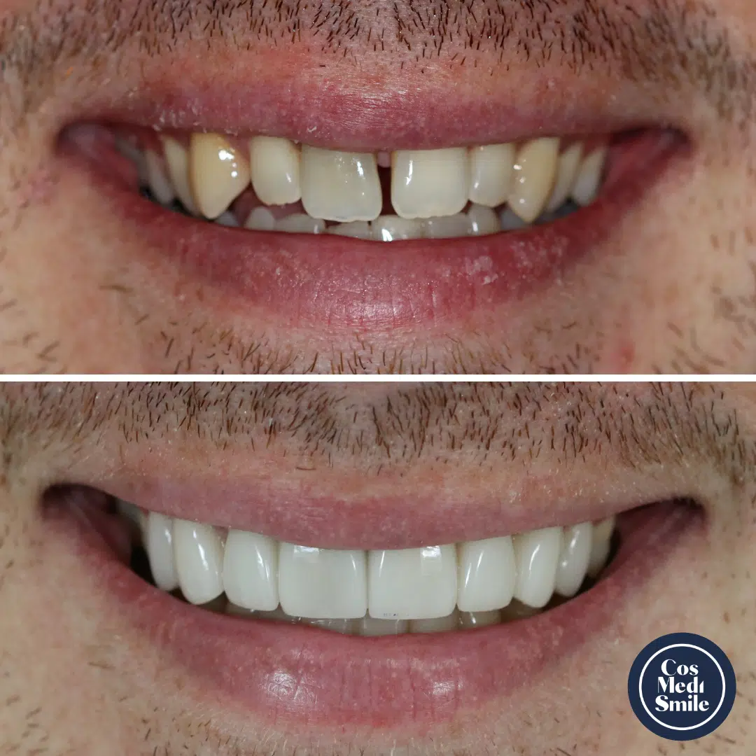 Smile Makeover 62, Porcelain Veneers