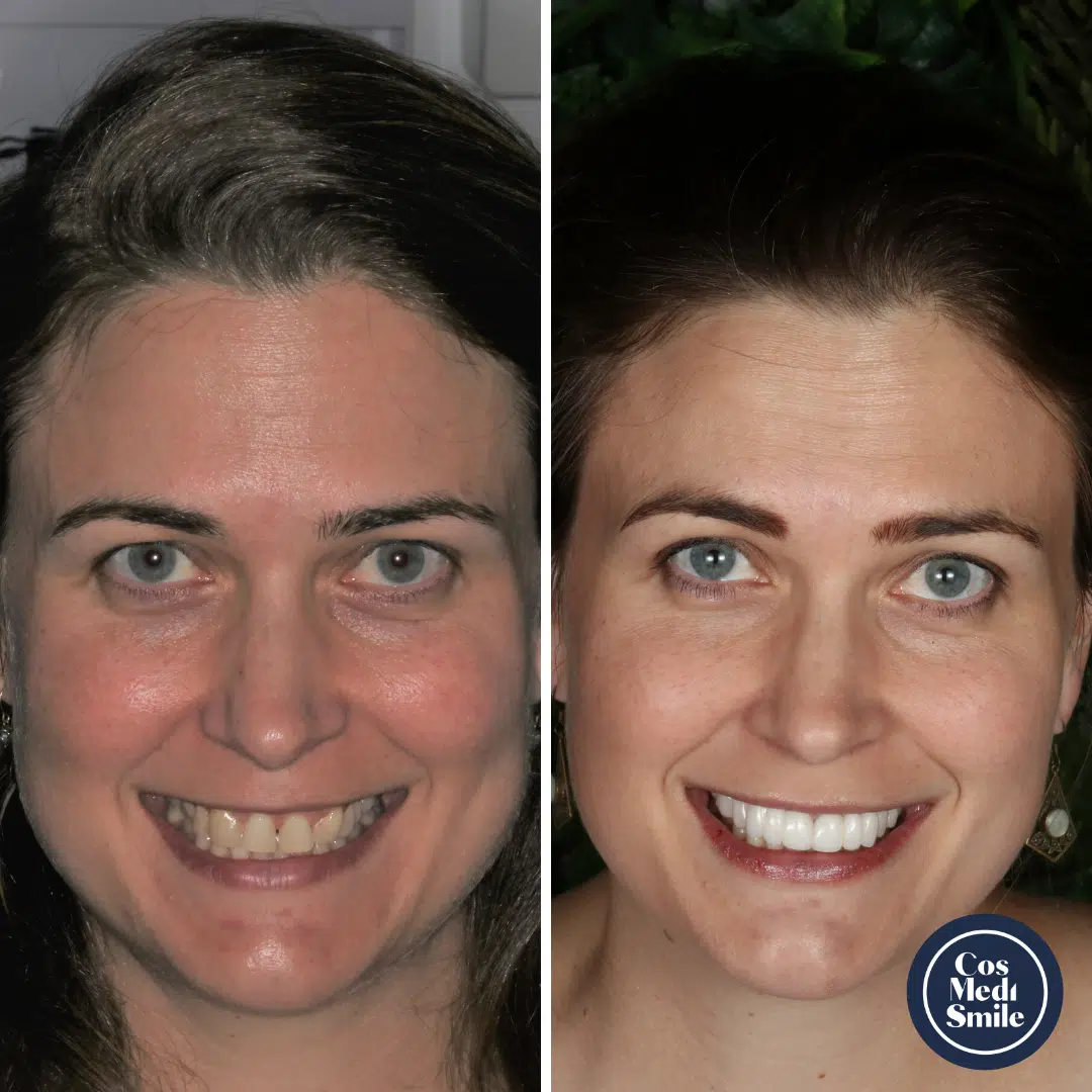 Smile Makeover 63, Dental Crowns face