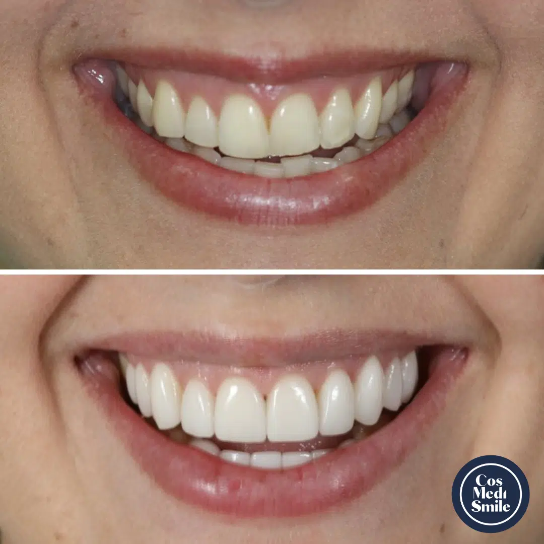 Smile makeover 21, veneers