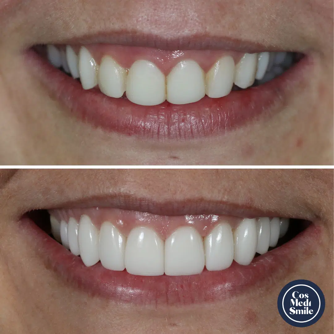 Smile makeover 25, veneers