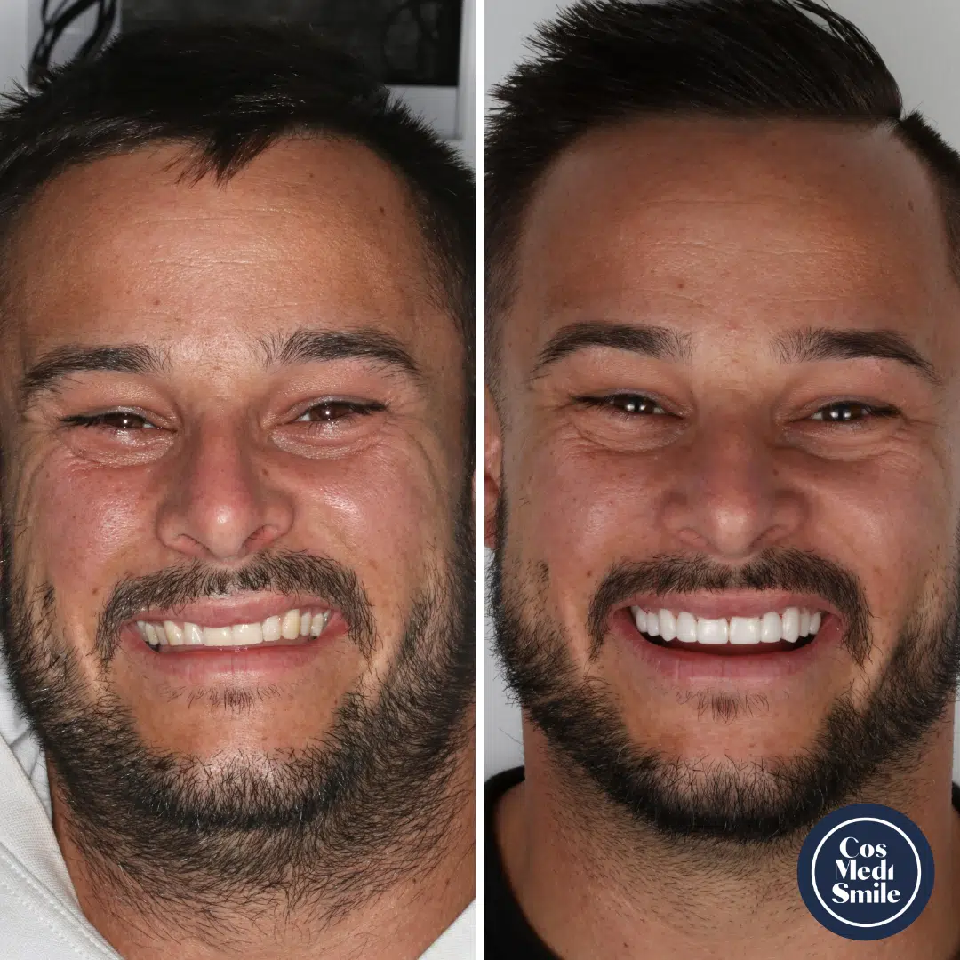 Smile makeover 35, Porcelain Veneers Face