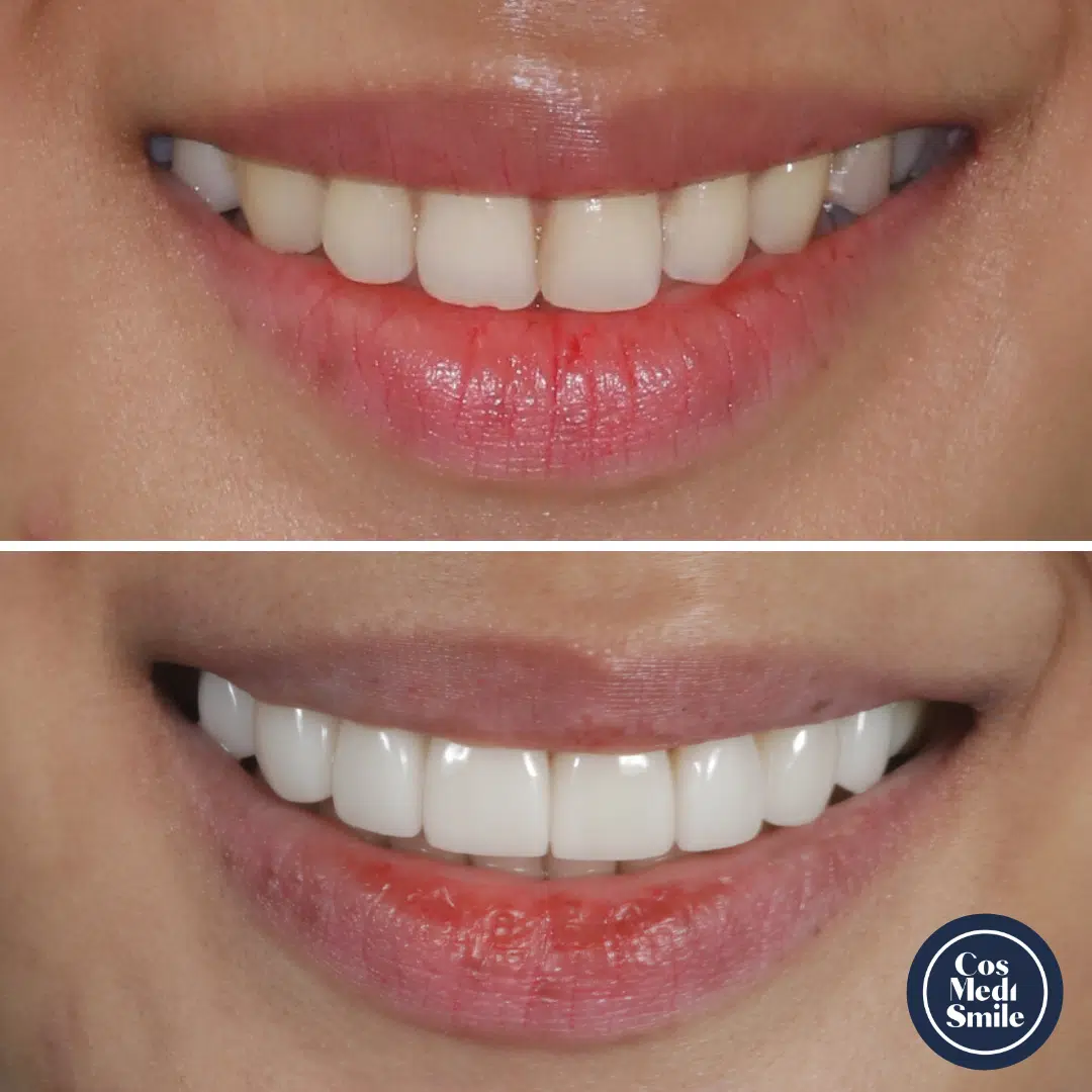 Smile Makeover 64, Dental Crowns