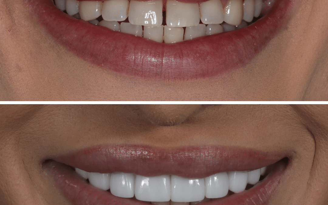 Smile Makeover 66