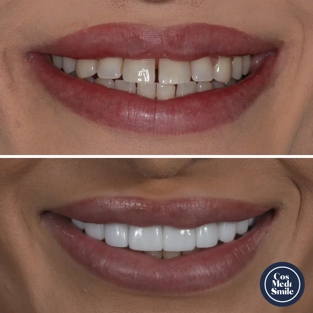 Smile Makeover 64, Dental Crowns