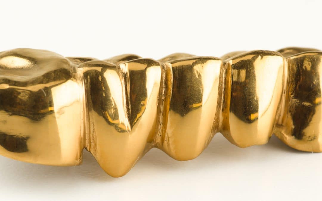 Signature Style with Gold Veneers and Gold Dental Crowns
