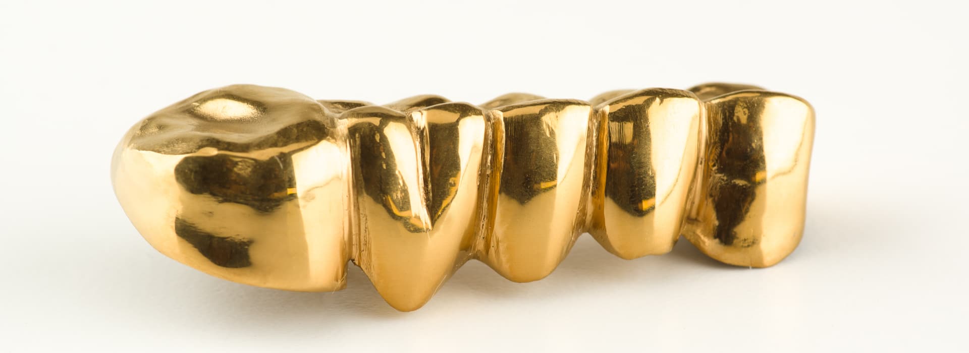 Signature Style with Gold Veneers and Gold Dental Crowns