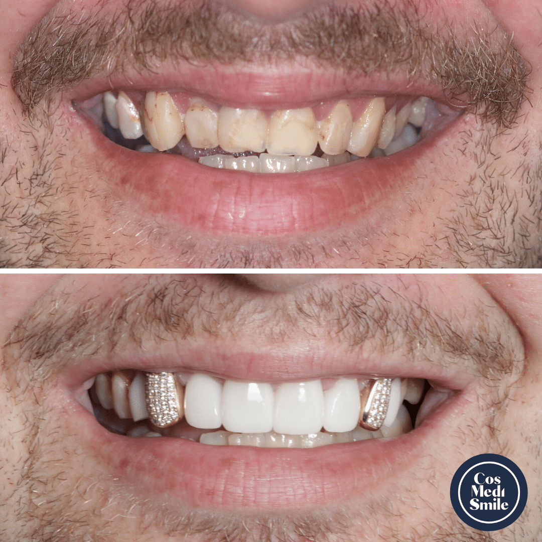 Smile Makeover 68 Dental Crowns Smile Makeover 68 Dental Crowns