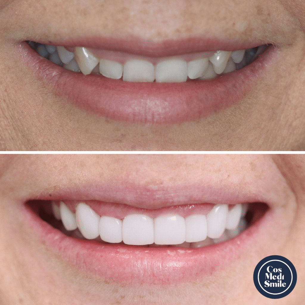 Smile Makeover 70 Porcelain Veneers