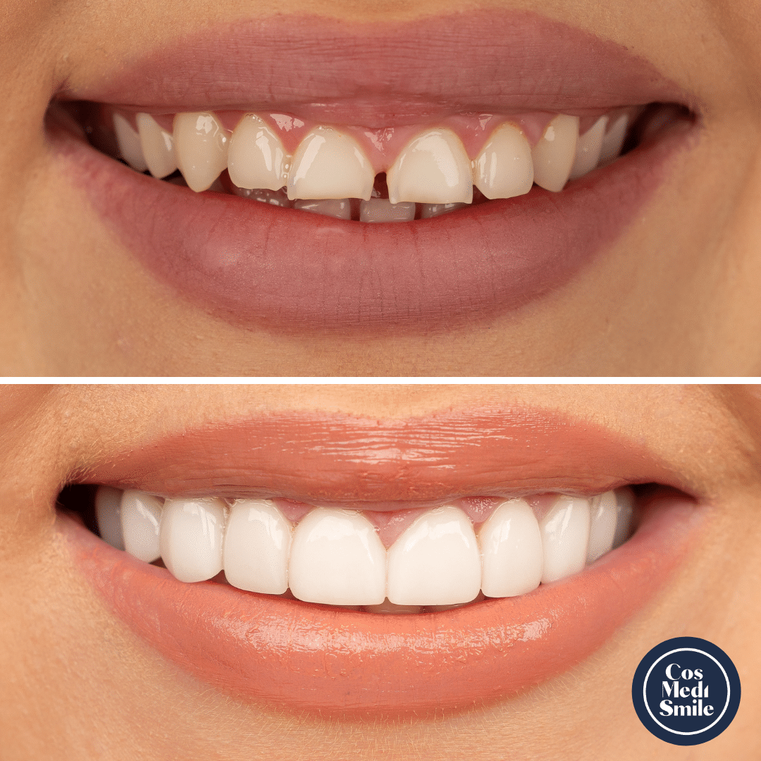 Smile Makeover 72, Porcelain Veneers