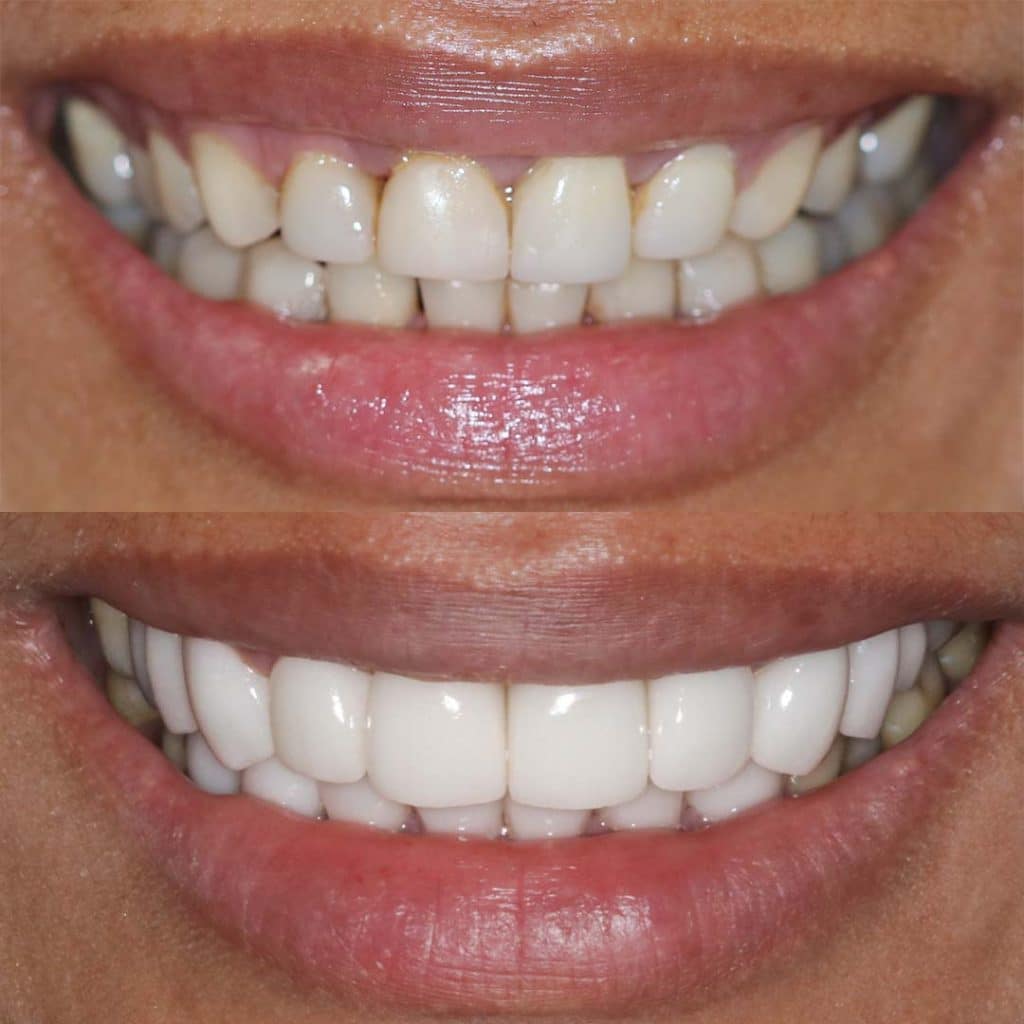Before and After 55, Veneers