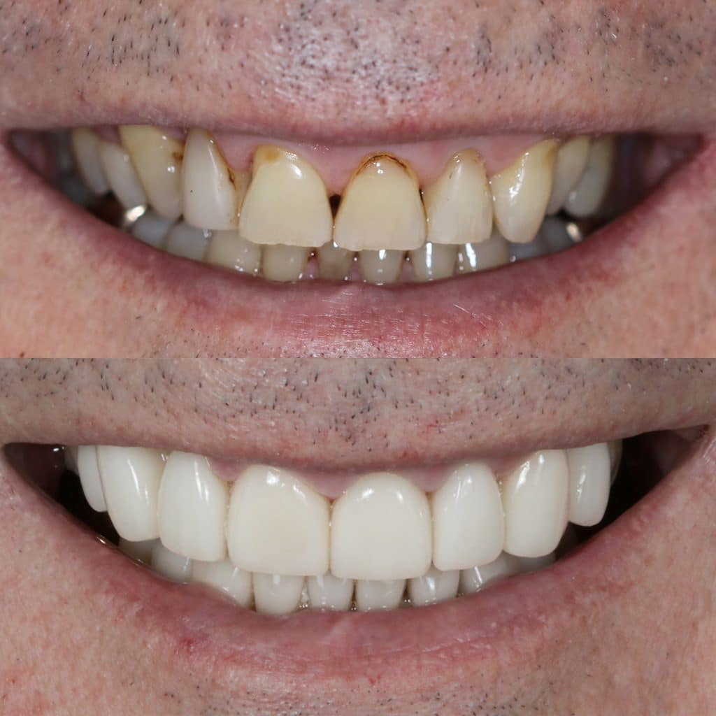 Before and After 74, Veneers