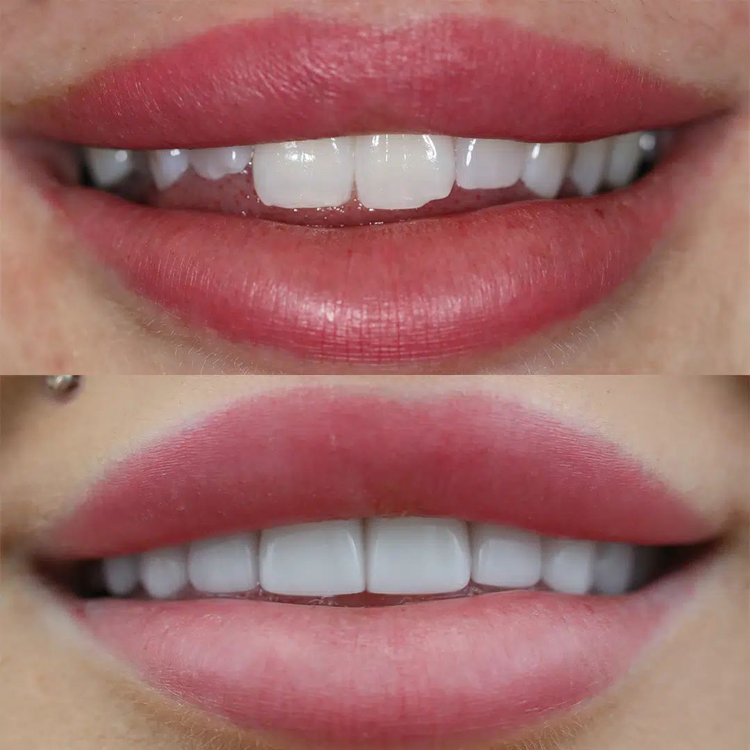 Before and After 75, Veneers