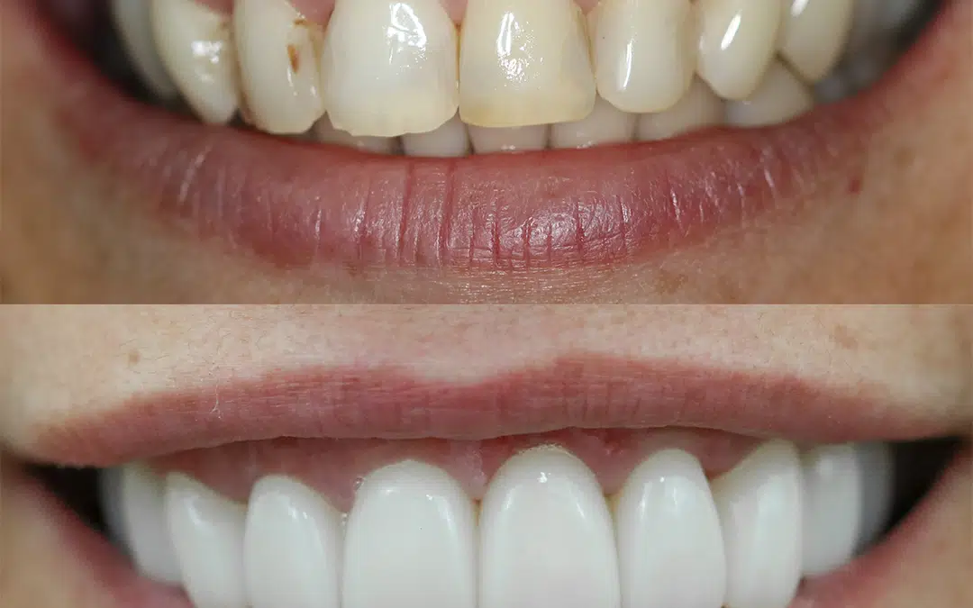 Smile Makeover 76