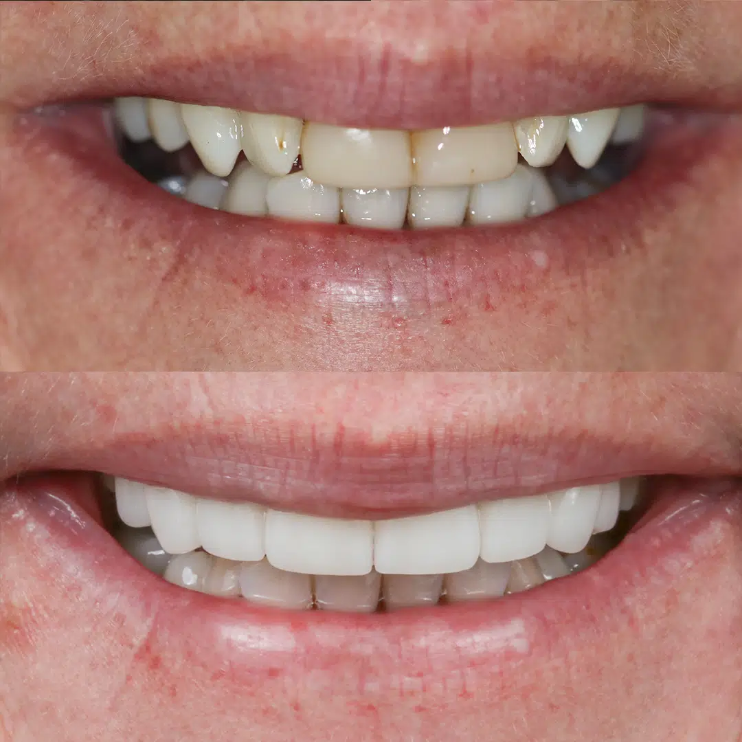 Before and After 78, Veneers