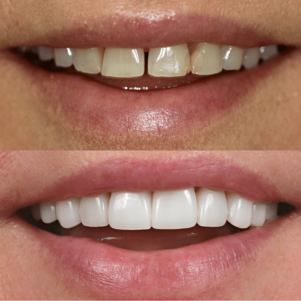 Before and After 79, Veneers
