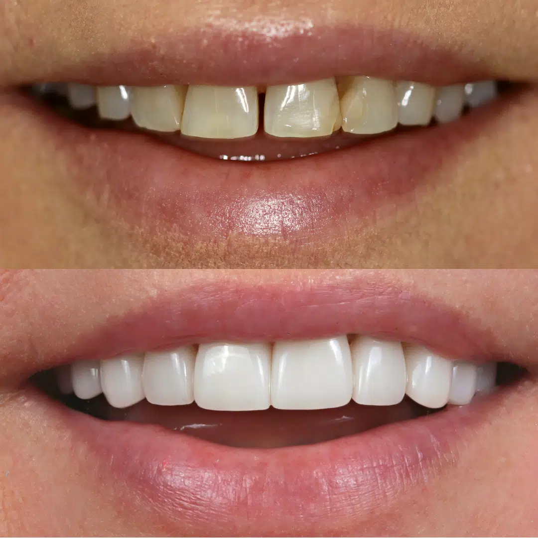 Before and After 79, Veneers