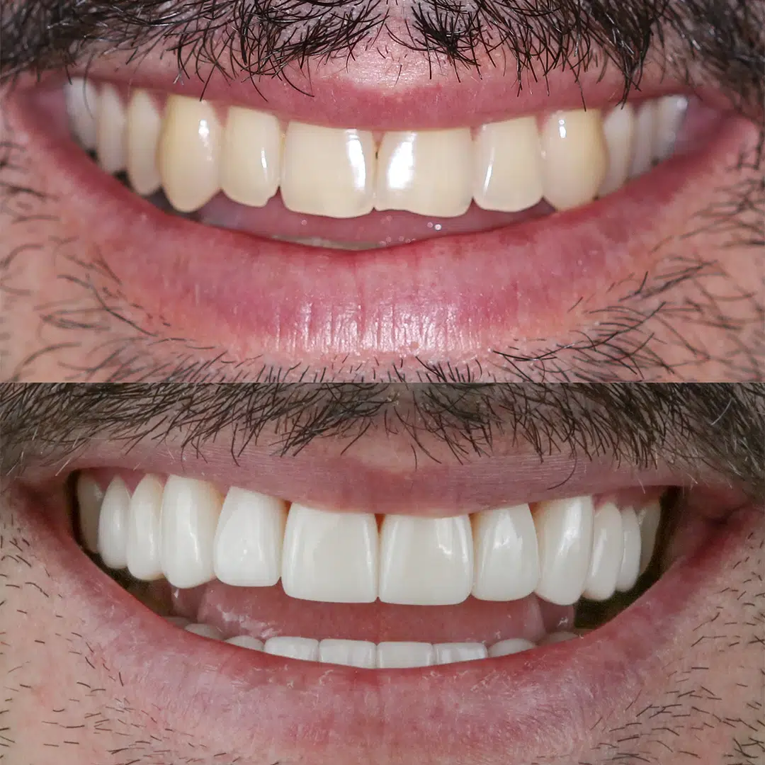Before and After 79, Veneers