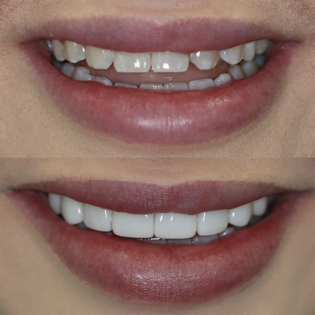 Before-After-100-Veneers