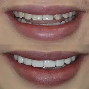 Before-After-100-Veneers