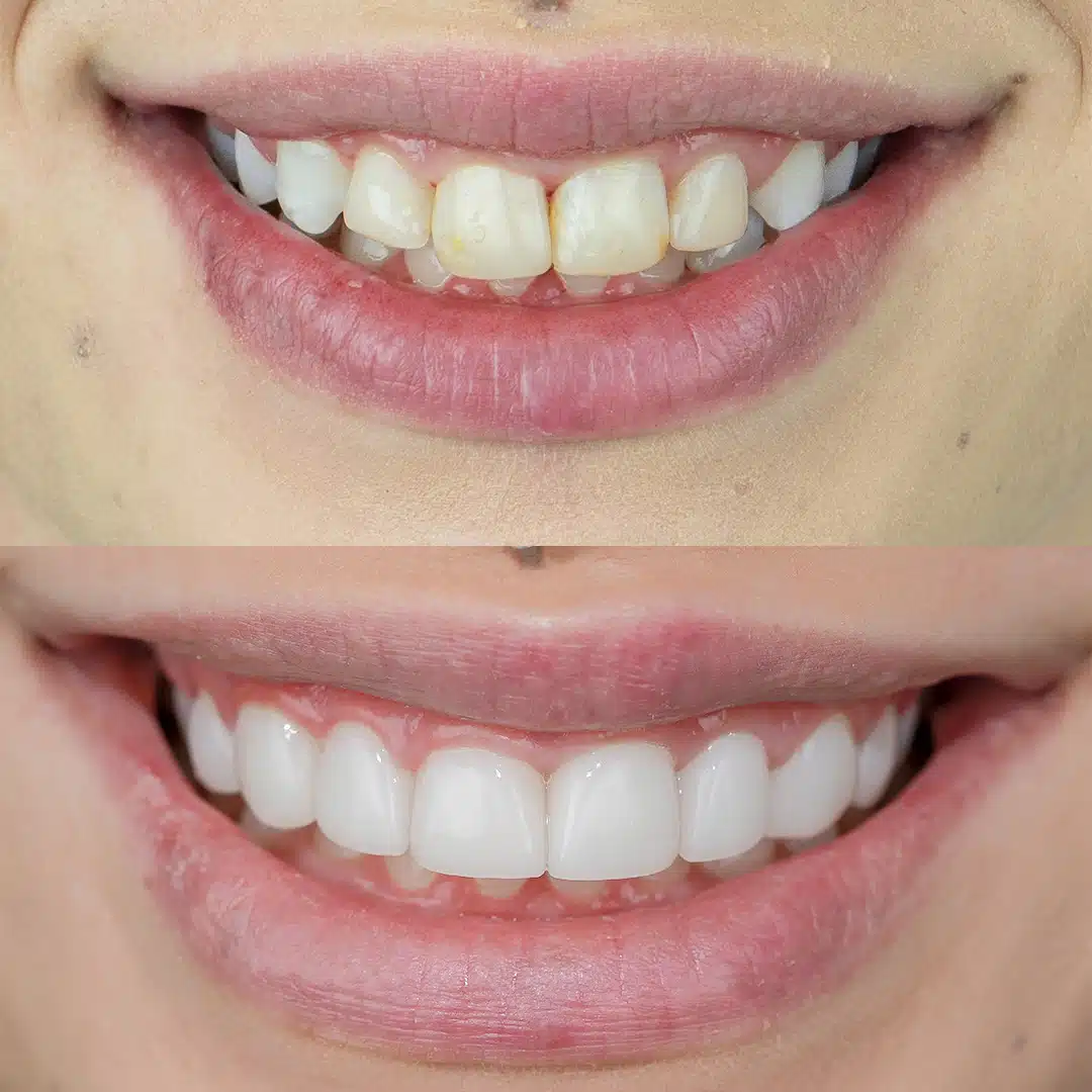 Before-After-101-Veneers