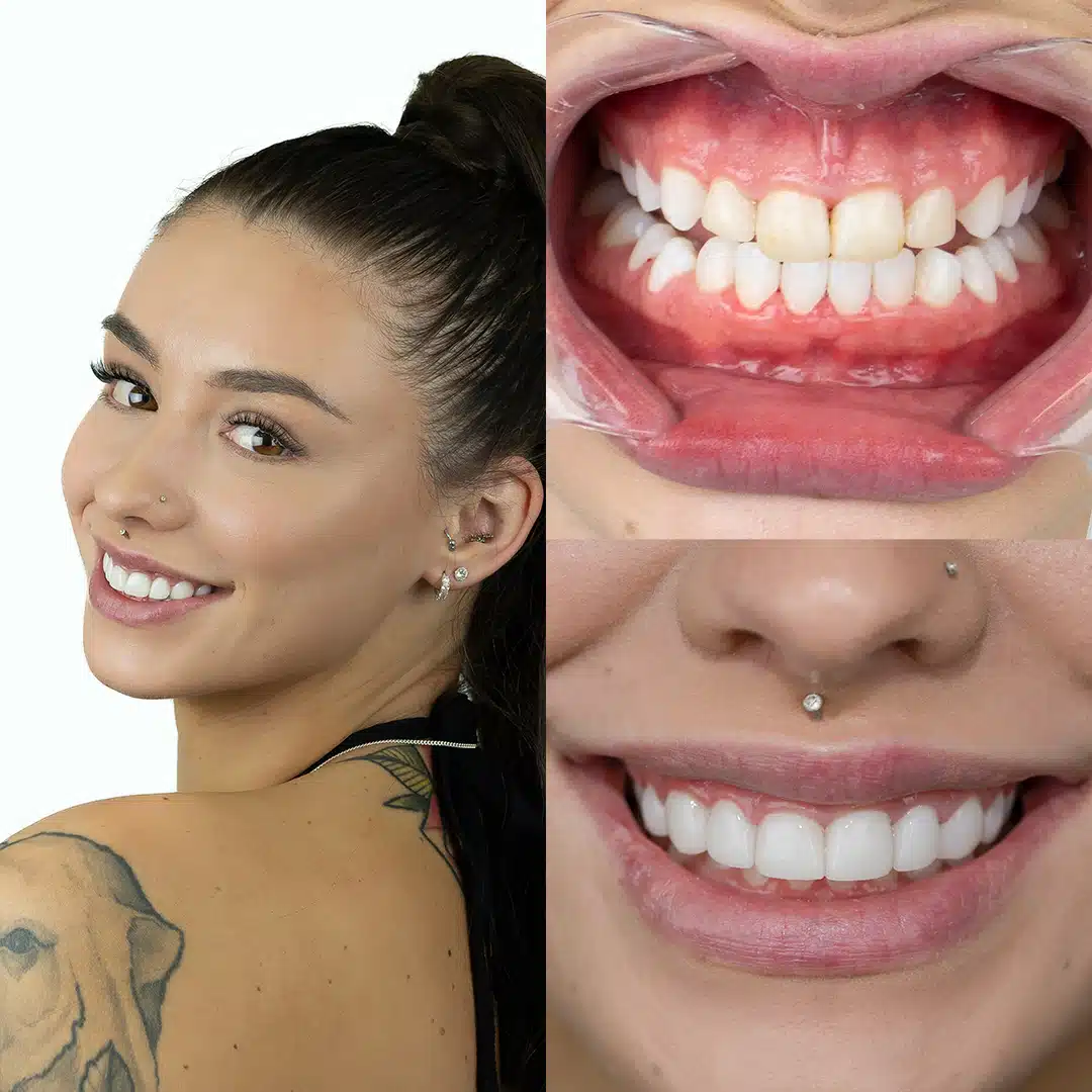 Before-After-101-Veneers-face