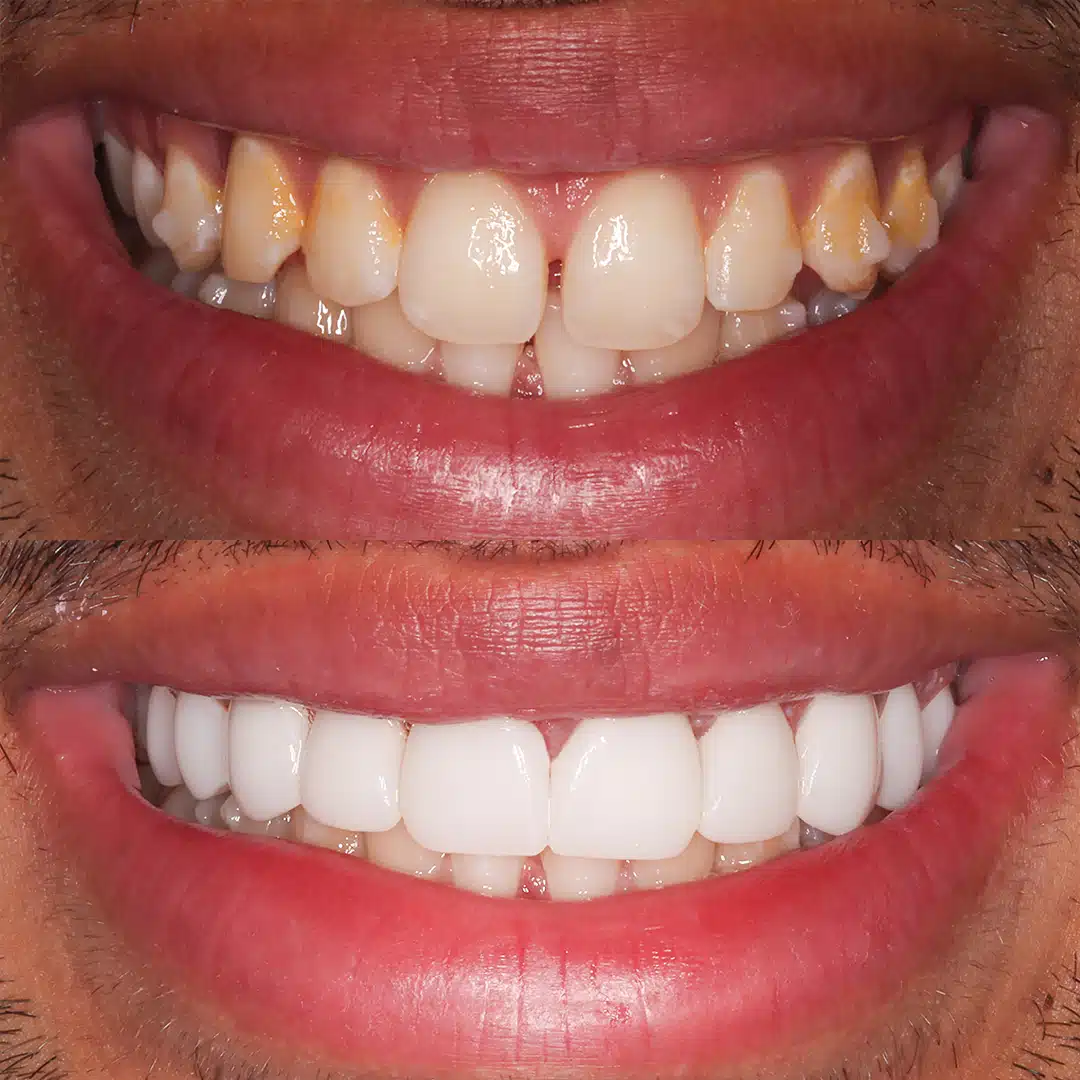 Before-After-101-Veneers