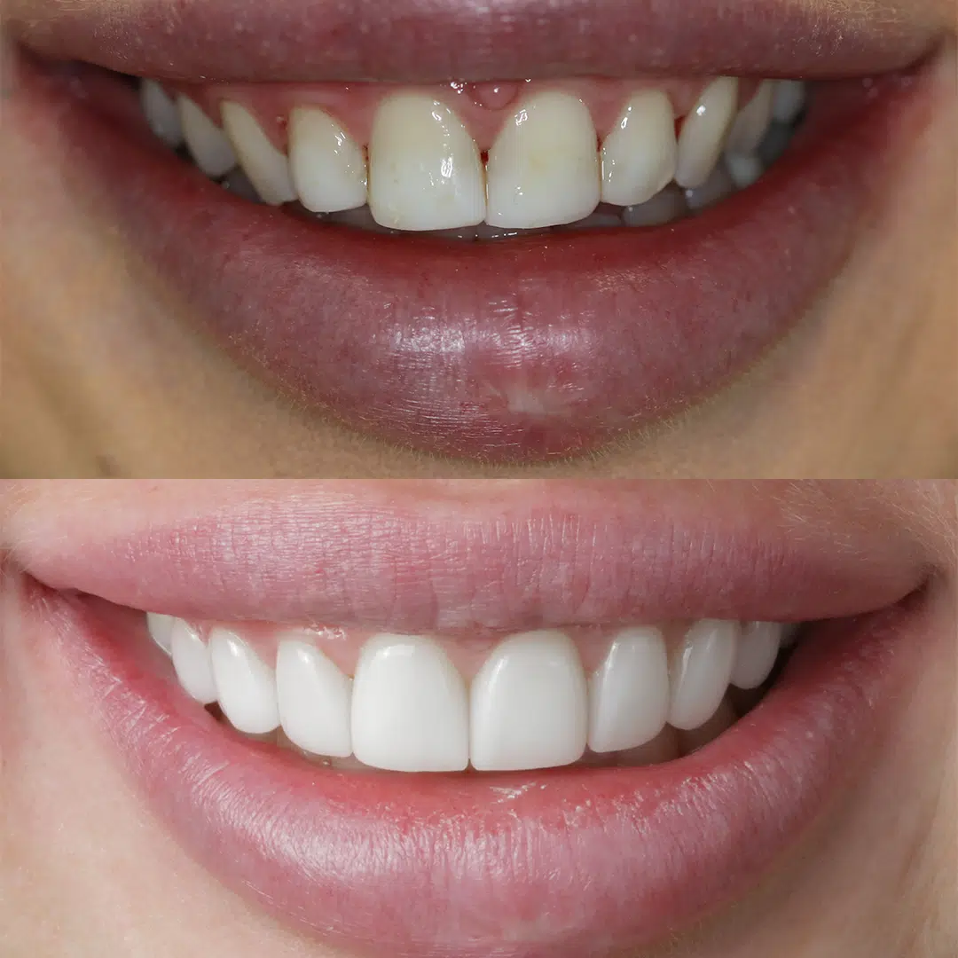 Before-After-80-Veneers