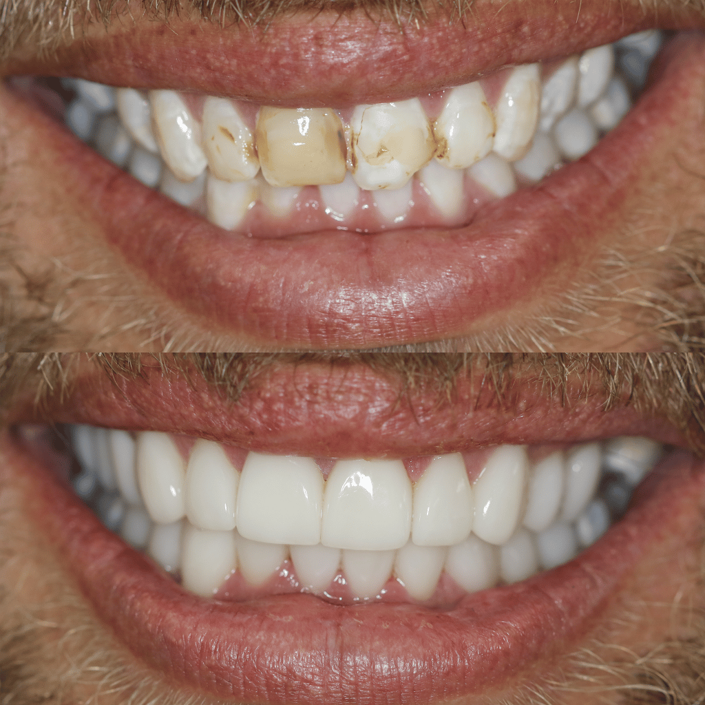 Before-After-85-Veneers