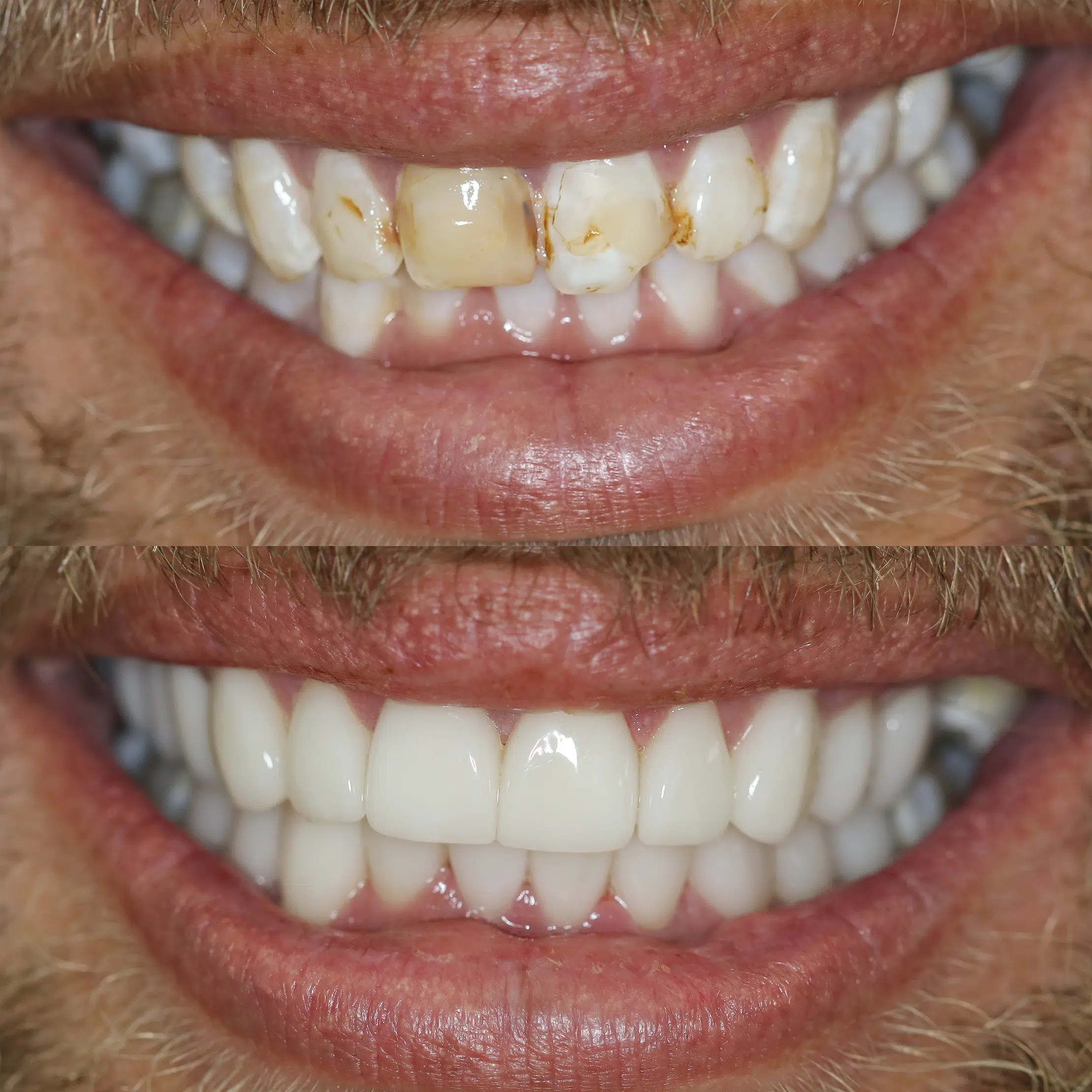 Before-After-85-Veneers