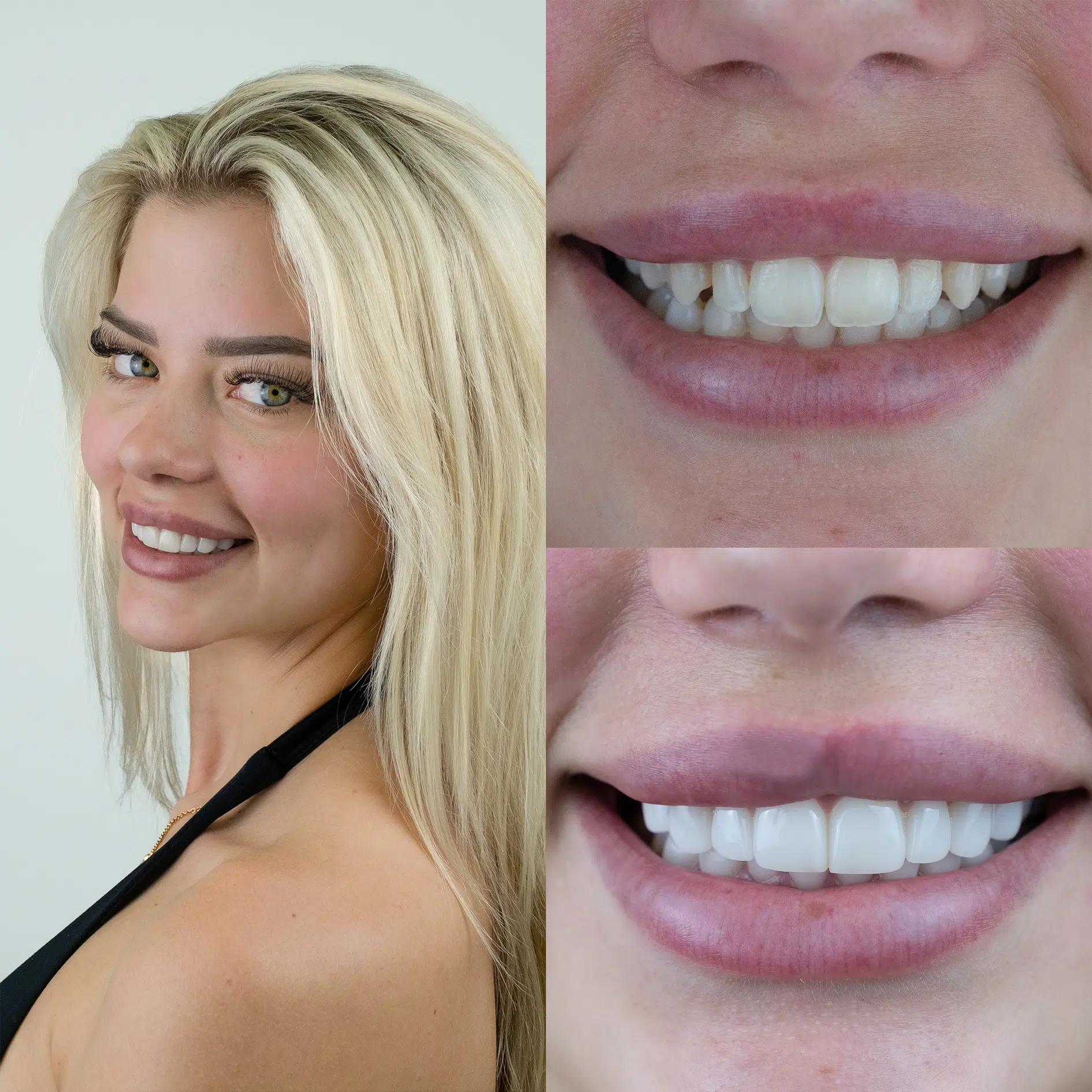 Before-After-86-Veneers-face