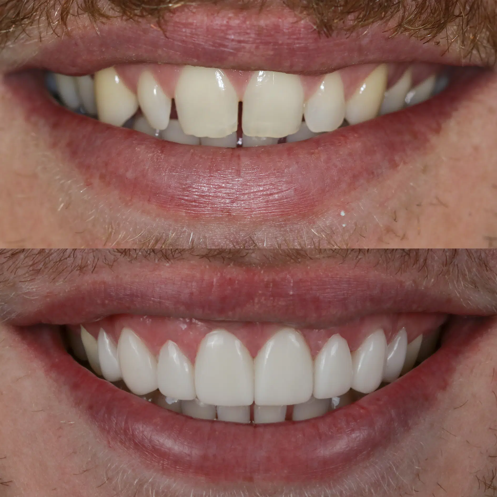 Before-After-89-Veneers