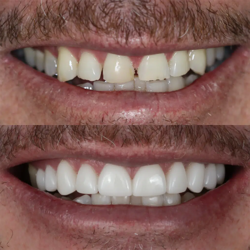 Before-After-91-Veneers