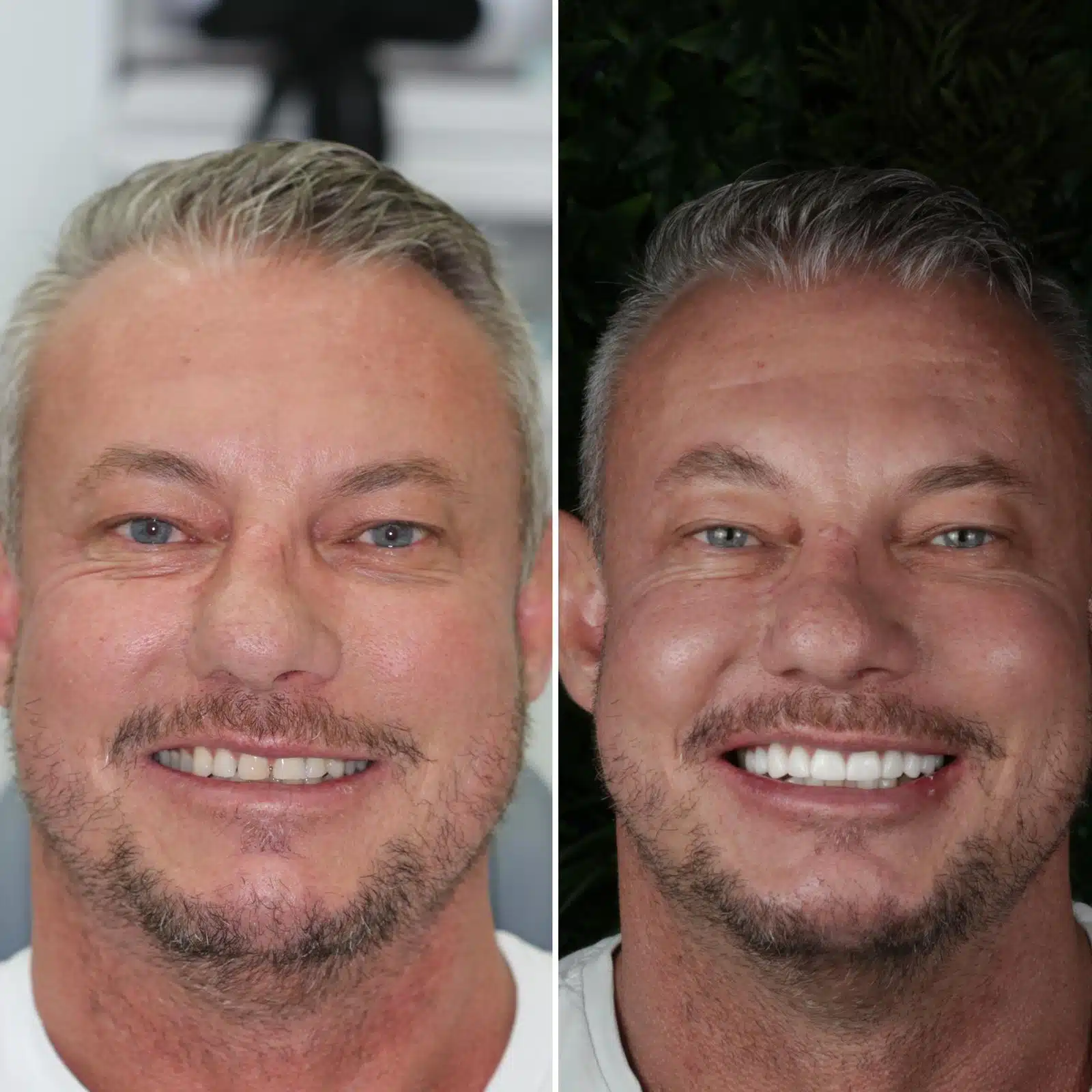 Before-After-91-Veneers-face