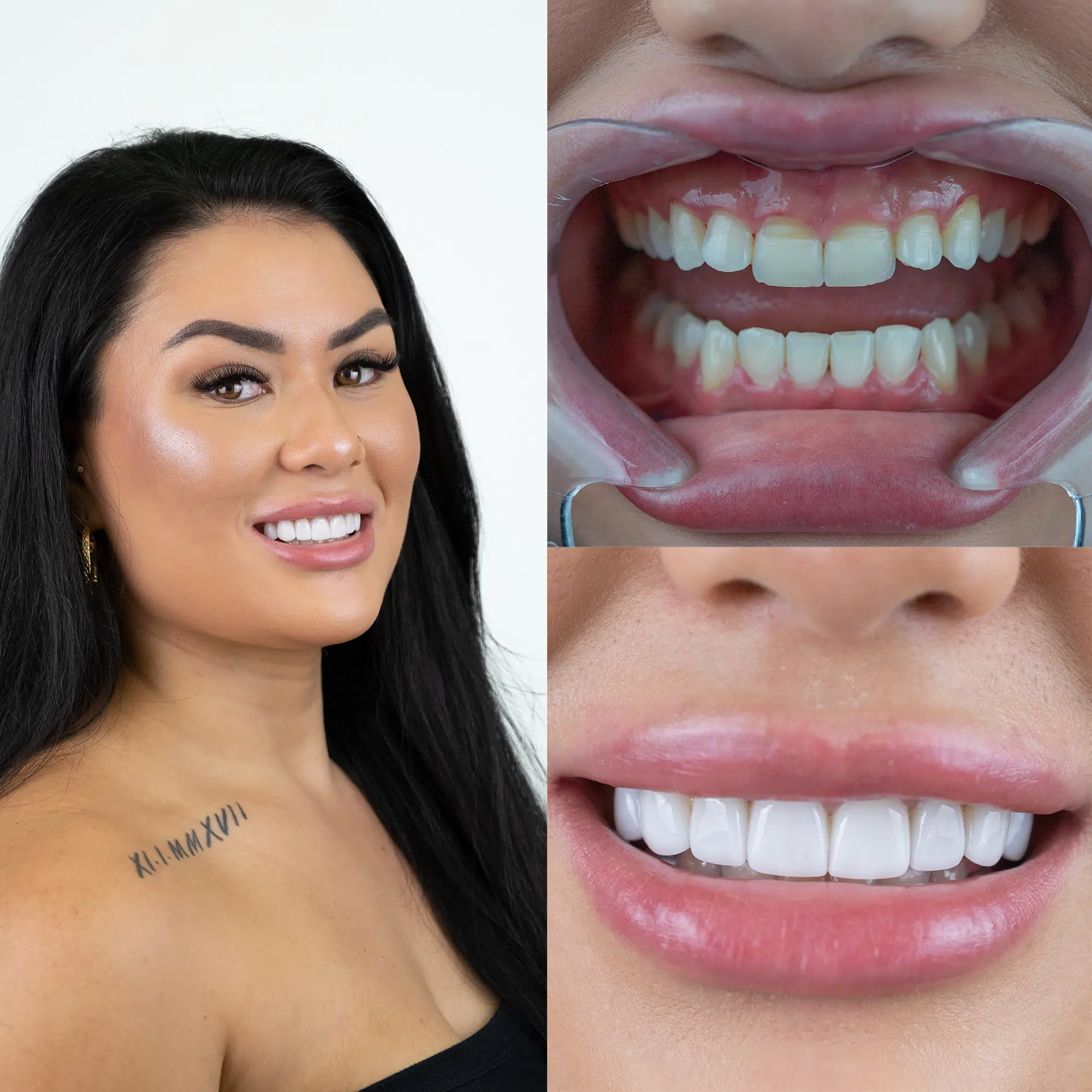 Before-After-94-Veneers-face