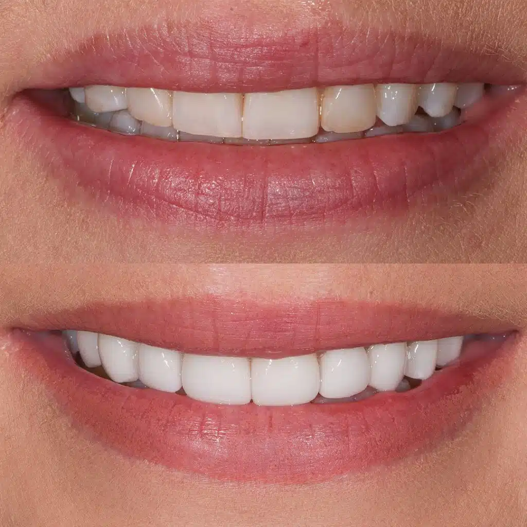 Before-After-95-Crowns