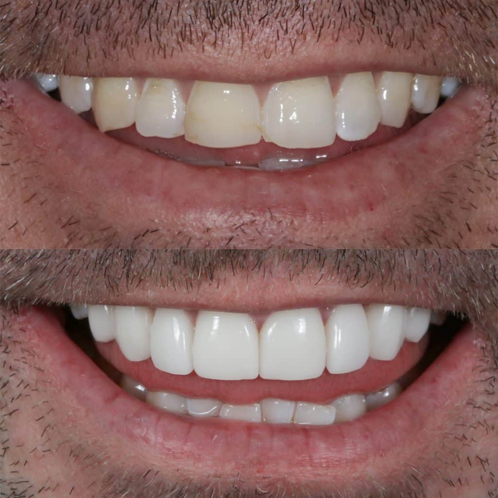 Before-After-97-Veneers