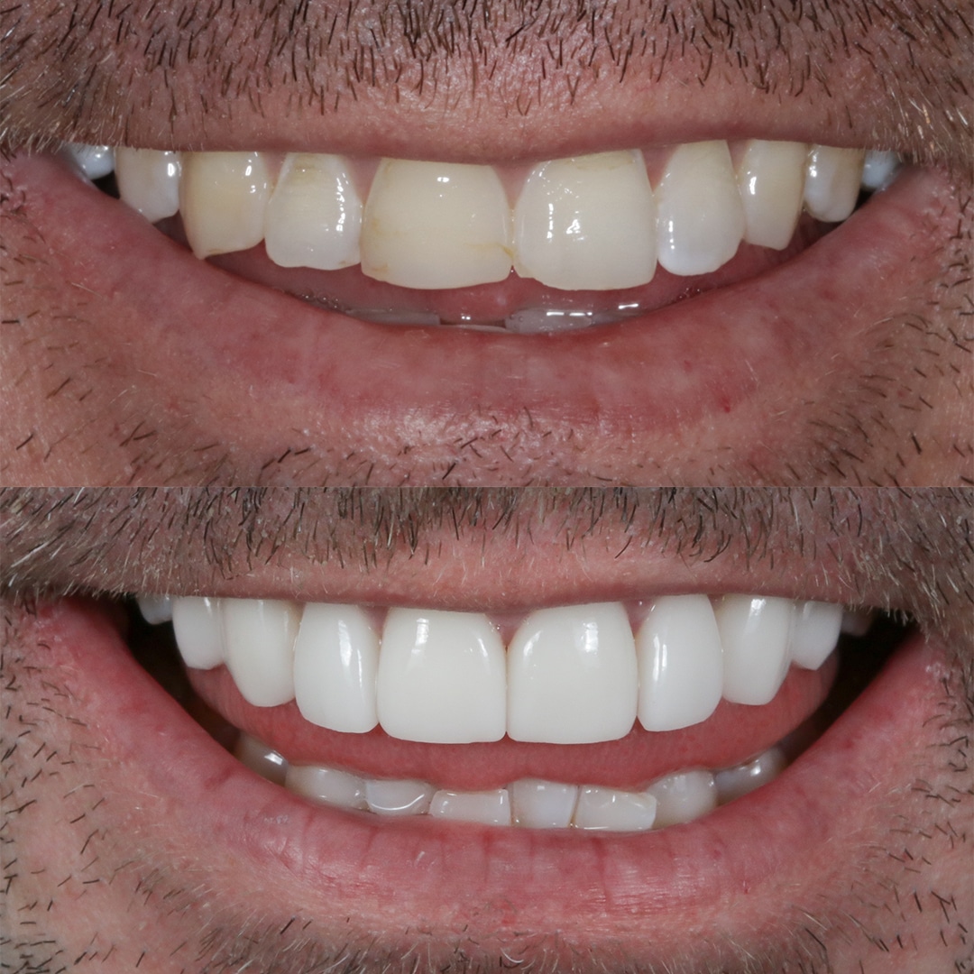 Before-After-97-Veneers