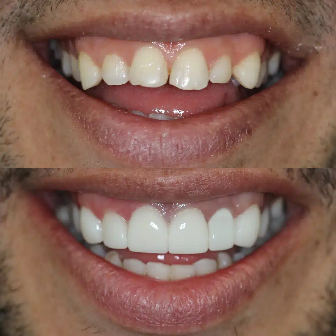 Before-After-98-Veneers