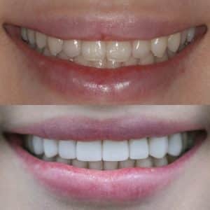 Before-After-99-Veneers