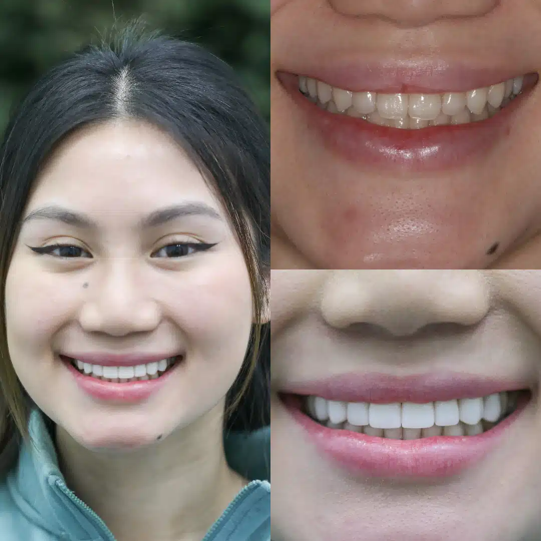 Before-After-99-Veneers-face