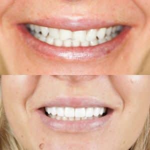 Smile Makeover, porcelain veneers, before and after photo.