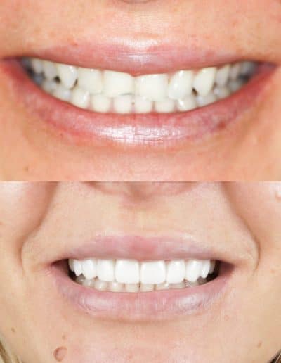 Smile Makeover, porcelain veneers, before and after photo.