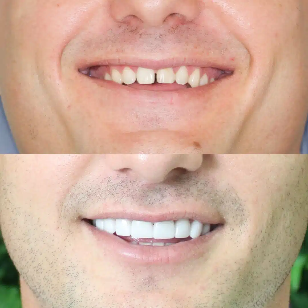 Smile Makeover, porcelain veneers, before and after photo.