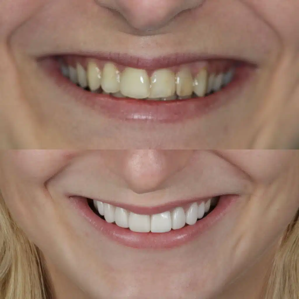 Zirconia Crowns before and after photo.