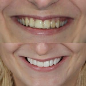 Zirconia Crowns before and after photo.