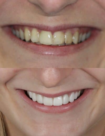 Zirconia Crowns before and after photo.