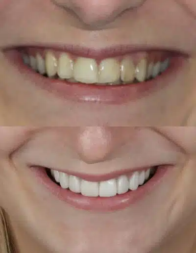 Zirconia Crowns before and after photo.