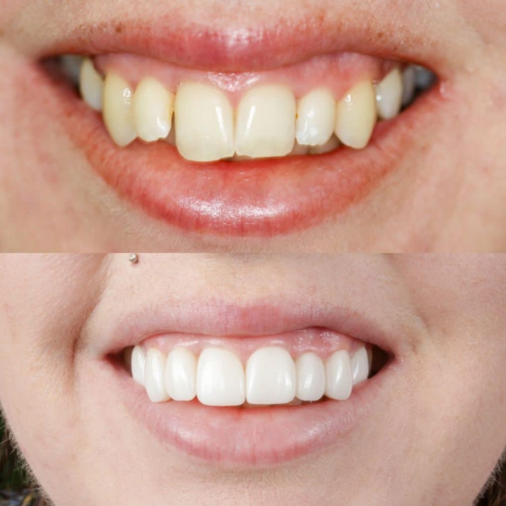 Smile Makeover, porcelain veneers, before and after photo.